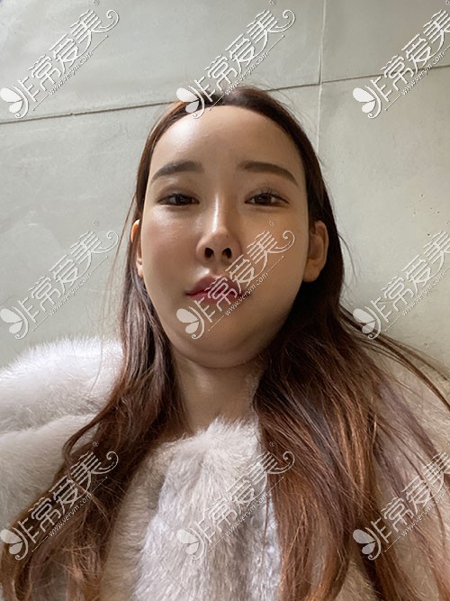 韩国芙莱思面部吸脂术前照片
