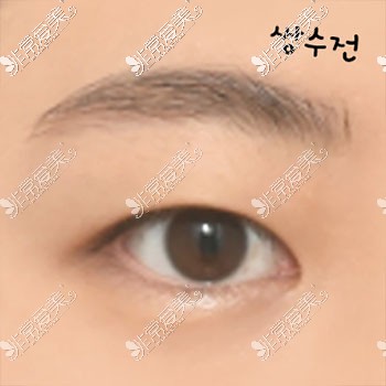 韩国icon做眼睛术前照