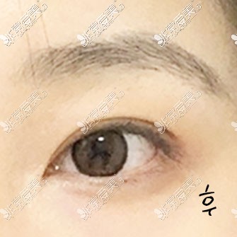 韩国icon双眼皮整形术后照片