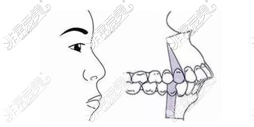 龅牙示意图
