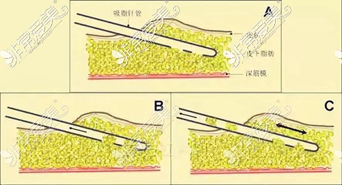 南京抽脂肪要多少钱?从这份价格表来看哪里吸脂手术便宜