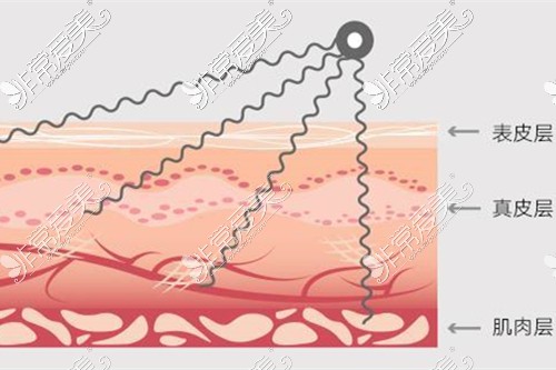 皮肤分层示意图