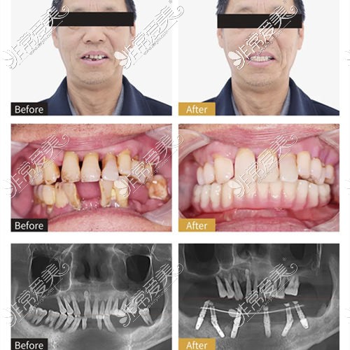 合肥佳冠口腔種植牙前后對比照片