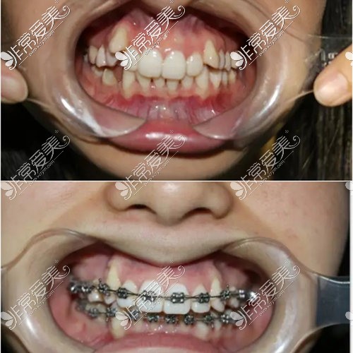 戴政正畸医生牙齿矫正前后对比照片