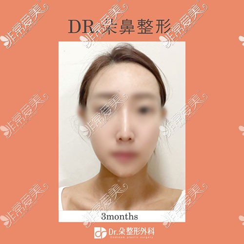 韩国dr朵鼻整形三个月恢复照
