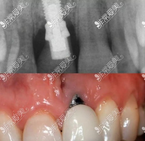 牙齿种植后周边牙槽骨被吸收