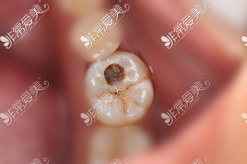 蛀牙龋坏的牙齿虫洞