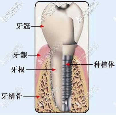 种植牙结构图示