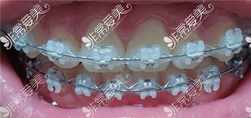 牙齿矫正中后期牙齿状态