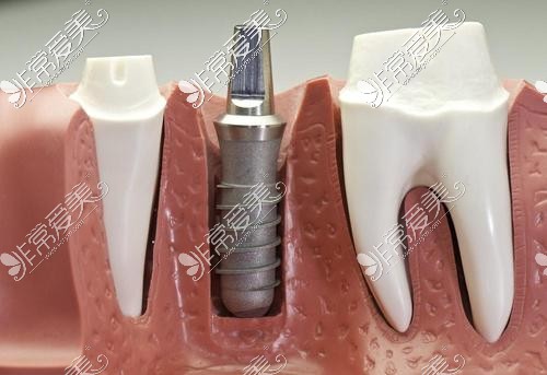 牙医没说的种植牙危害有哪些？这几点你一定不知道