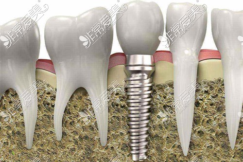 牙医没说的种植牙危害有哪些？这几点你一定不知道