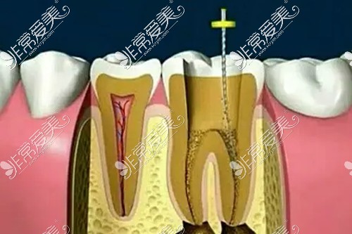 根管治疗示意图