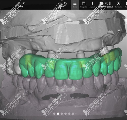 种植牙设计的CT