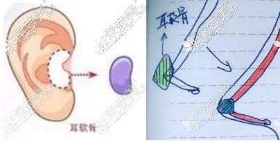 公布5家医院成都耳软骨隆鼻的价钱,从4000元到4W有啥不同!