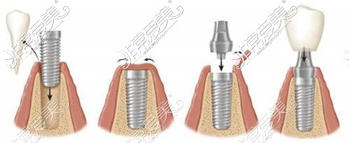 种植牙过程