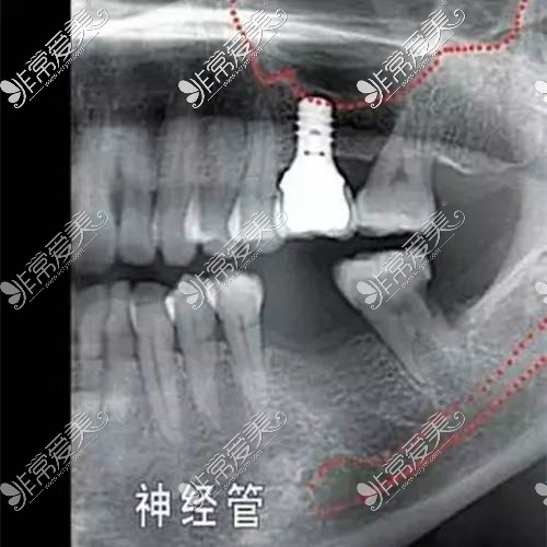 下牙槽神经管图片