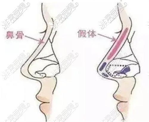 成都艺星整形美容隆鼻示意图