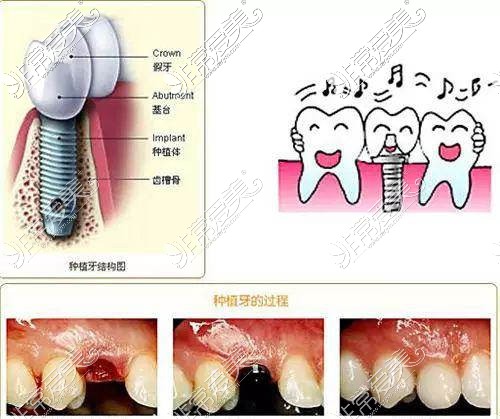 种植牙分解图