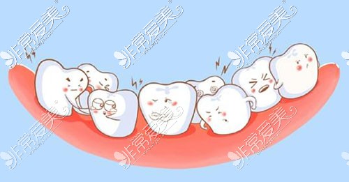 牙列拥挤漫画图