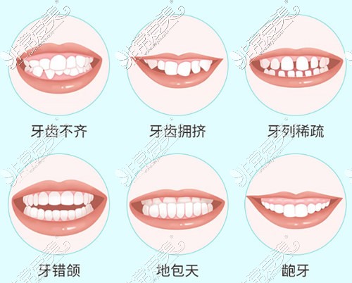 20岁矫正牙齿晚不晚 ？分享我22岁毕业整牙的真实经历！