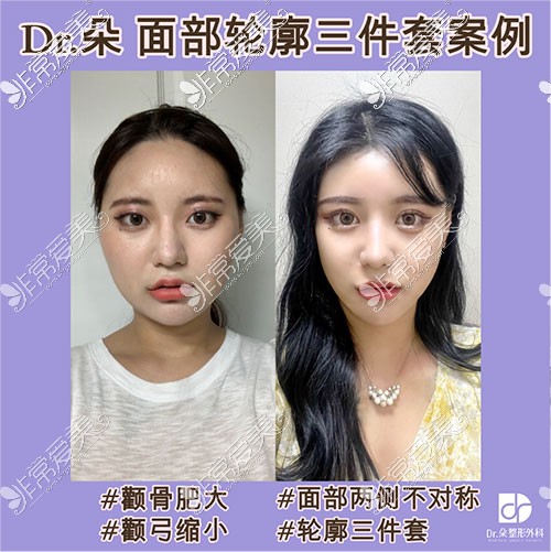 韩国dr朵面部轮廓手术