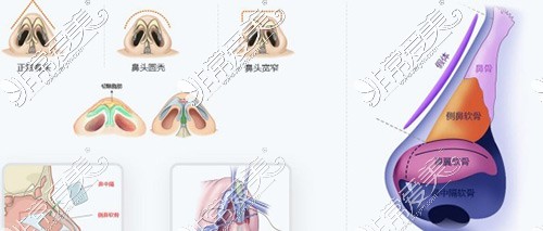 隆鼻示意图