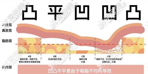 肚子吸脂后遗症凹凸不平示意图