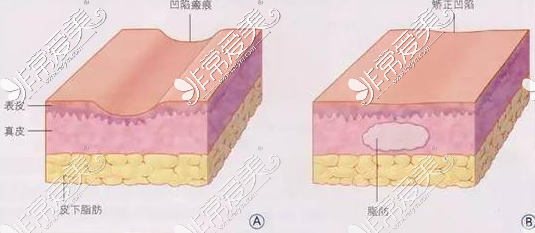 脂肪填充一年吸收没了?是真的吗?现在告诉你能维持多久