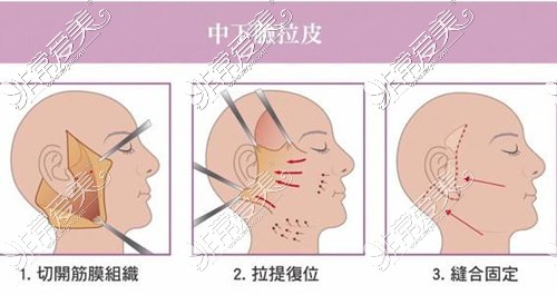 中下面拉皮手术示意图