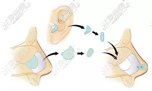 耳软骨隆鼻示意图