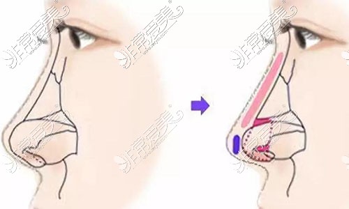 隆鼻示意图