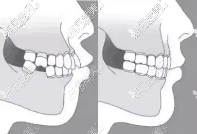 牙齿整齐但是牙床外凸的牙性问题