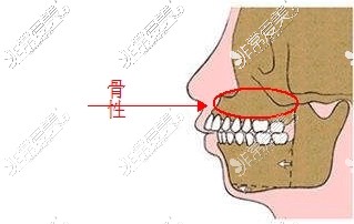 牙齿整齐但是牙床外凸骨性原因