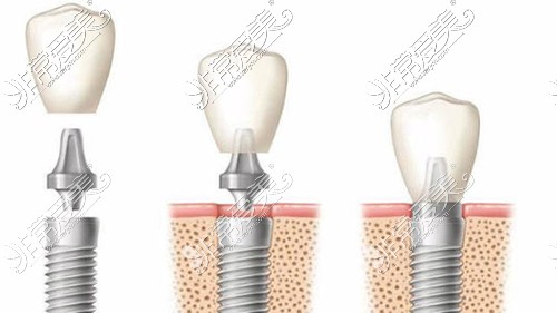种植牙步骤拆分