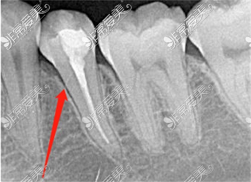 做好根管治疗的牙齿