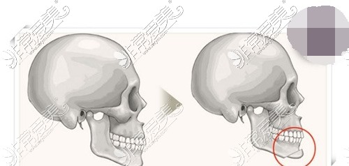 假体垫下巴手术示意图