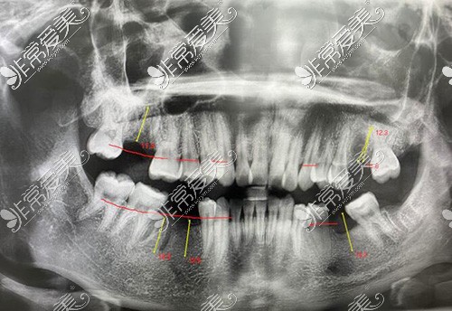 种植牙改善CT图照片