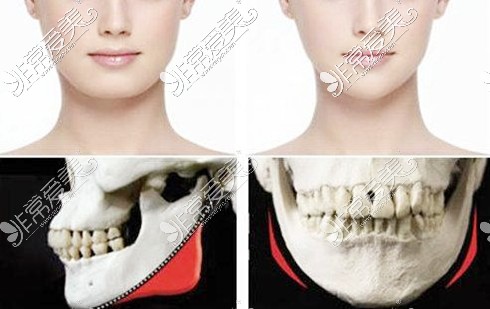 下颌角磨骨术3D图