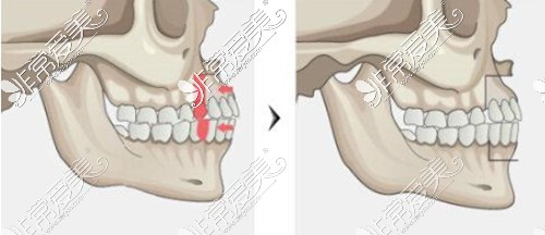 正颌手术示意图