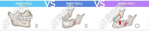 突嘴手术类型