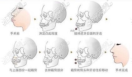 下巴后缩