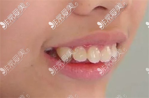 重度的骨性龅牙带牙套有用吗