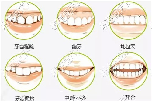 6种牙齿畸形示意图