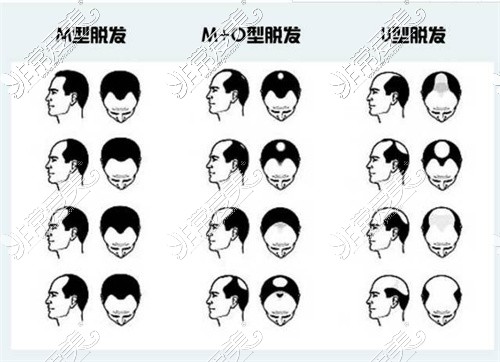 脱发的几种类型图片