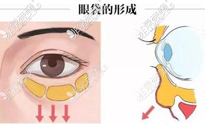 眼袋的形成卡通图展示