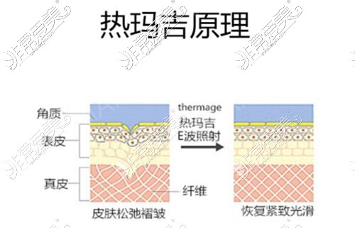 熱瑪吉除皺原理