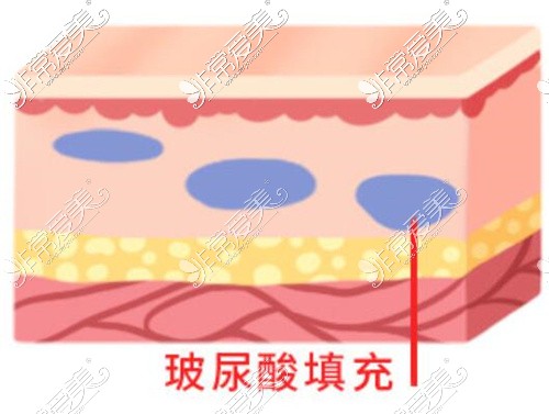 静态川字纹填充后疗效示意图