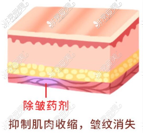 动态川字纹填充后疗效示意图