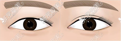 双眼皮手术可能是导致眼睛凹进去的原因