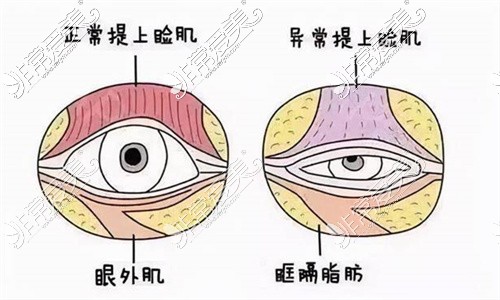 正常和异常眼提肌对比